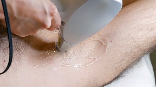 Trouvez le meilleur centre d'épilation laser Marseille : qui sont les experts ?